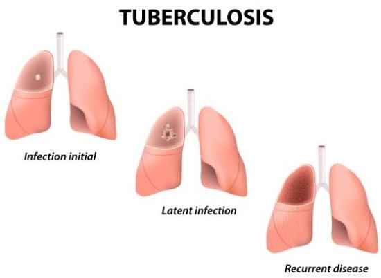 How To Treat Tuberculosis In Natural Way How To Treat Tuberculosis In Natural Way
