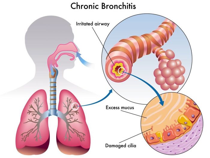 What is a good home remedy for a bronchitis cough?