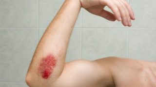 9 Essential Oils for Bruises Healing