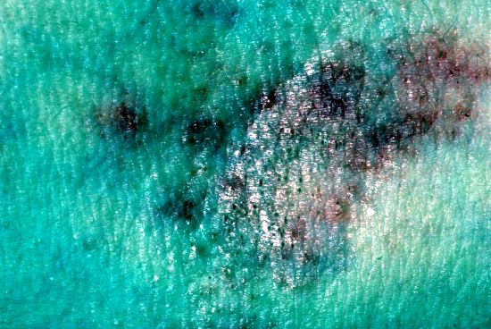 Home Remedies for Shingles Home Remedies for Dermatitis Home Remedies Home Remedies for Shingles Home Remedies for Dermatitis Home Remedies