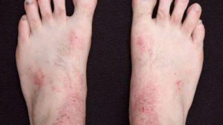 Man's feet with a skin rash or eczema