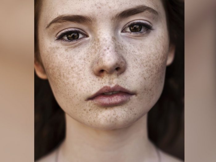 11 Amazing Home Remedies for Freckles | Organic Facts