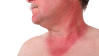 Close-up view of a man with sunburn marks on his neck