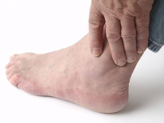 How can you use diet as a remedy for gout in your foot?