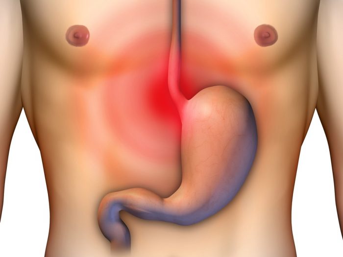 A graphic representing acid reflux