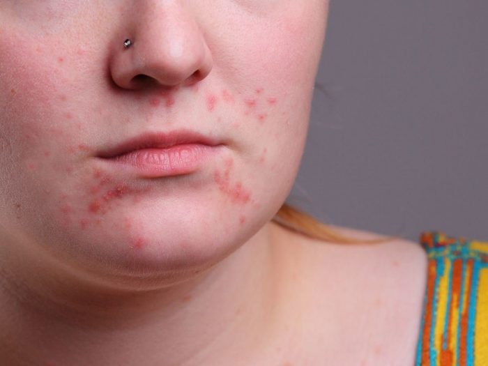 Home Remedies for Acne | Organic Facts