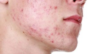 acne scar