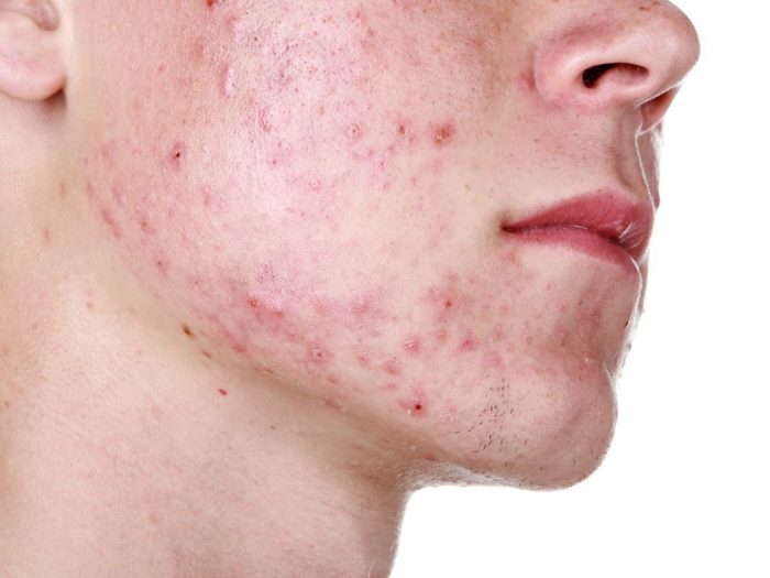 23 Remédios caseiros Para Cicatrizes da Acne 