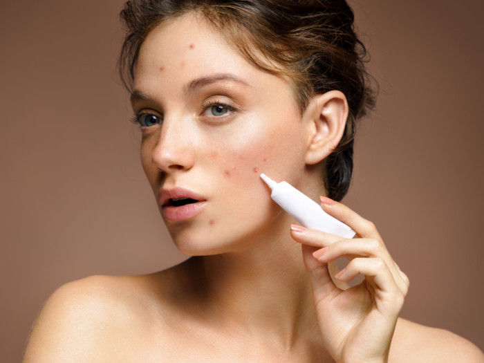 A face shot of a woman with acne on her face holding a tube