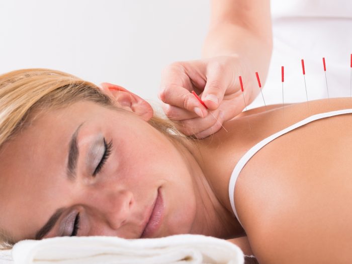 Acupuncture therapy being perfomed on a woman's back