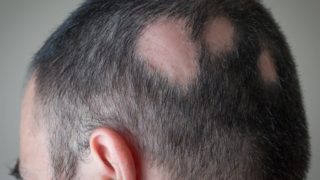 A man suffering from alopecia areata with bald patches on his head