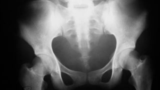 An X-ray film of the abdomen with ascites