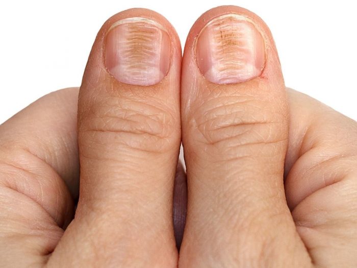 8 Best Treatments & Home Remedies for Beriberi Organic Facts