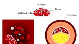 A 2D medical illustration of a blood clot