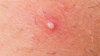 Home Remedies- List of Easy Home Remedies for Health Care | Organic Facts