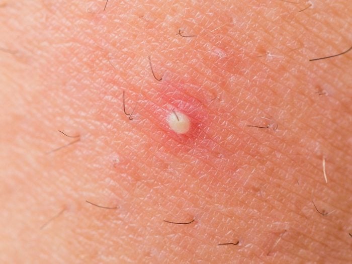 Slideshow: Boils and the Skin - WebMD