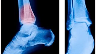 X-Ray of a foot from two different angles.