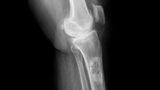 X-Ray slide of a knee joint