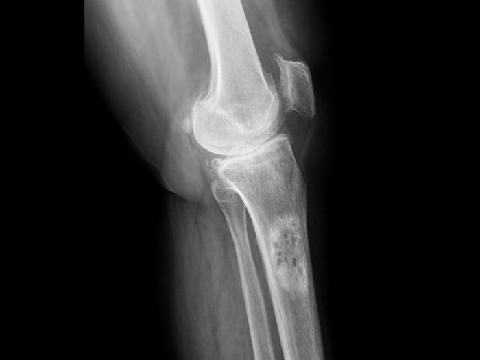 bone fragments in knee bone fragments in knee