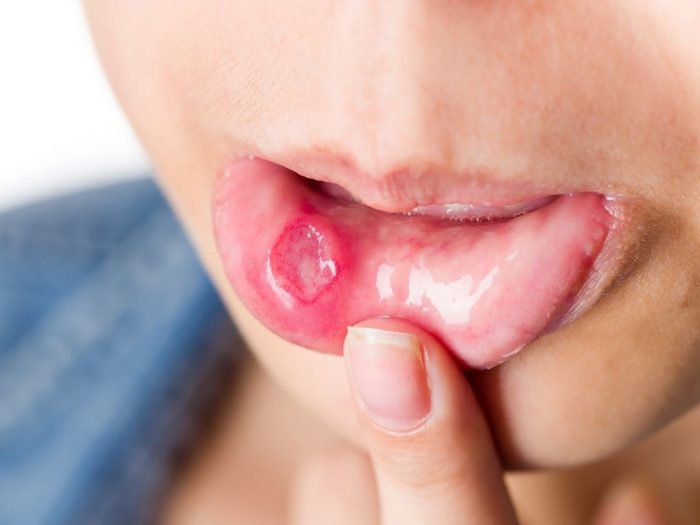 19 Best Home Remedies for Canker Sore | Organic Facts