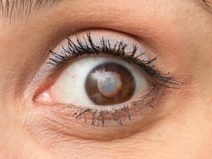 12 Efficient home remedies for Cataract