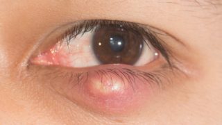 A close-up shot of an eyelid with a cyst