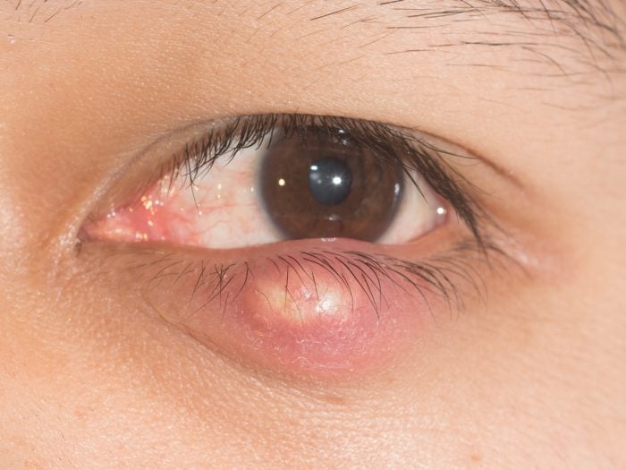 Chalazion Causes Symptoms Risk Factors And Treatments