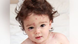 A small infant sitting on the bed suffering from chickenpox