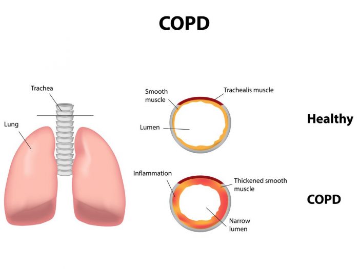 12 Effective Remedies for Chronic Obstructive Pulmonary 