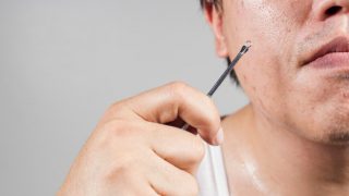 Close up of a man with clogged pores on his face holding a blackhead extractor