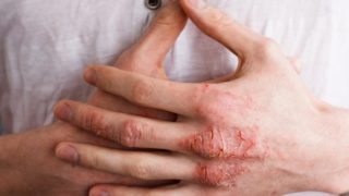 Man's hands with eczema resting on a white shirt
