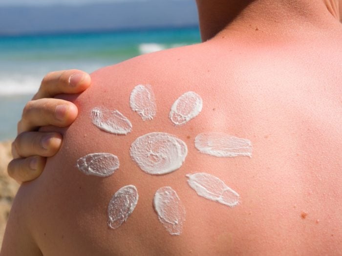 A young man suffering from sunburn applying sunscreen on his shoulders on the beach