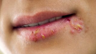 10 Best Essential Oils for Cold Sores