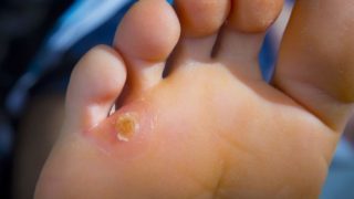 Corns and calluses on the sole of the feet