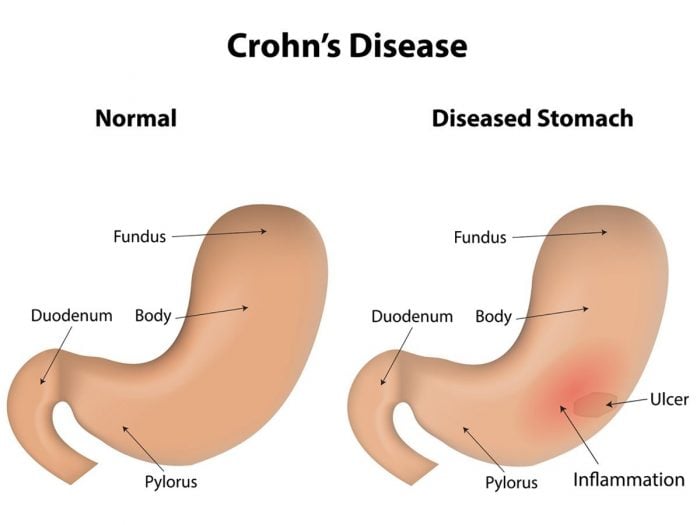 Researchers find two distinct genetic subtypes in Crohn's disease patients