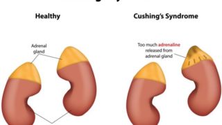Cushing's syndrome chart