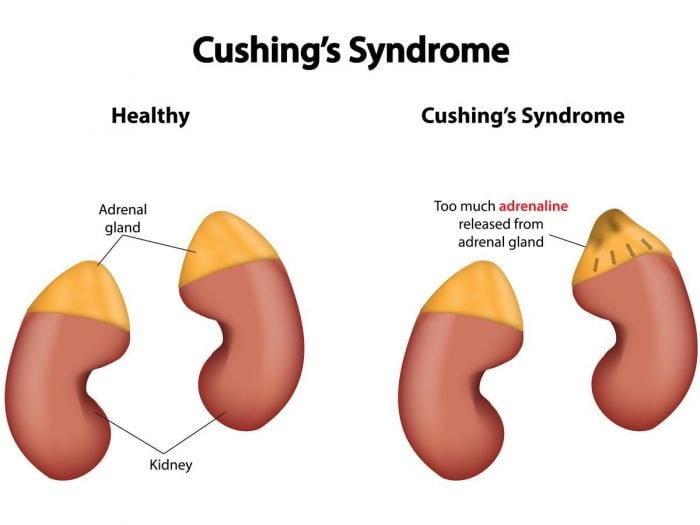 Cushing's syndrome chart