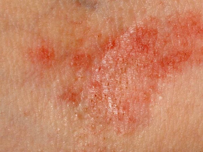 Contact Dermatitis Symptoms Causes And Treatments Ecig Canada Zone