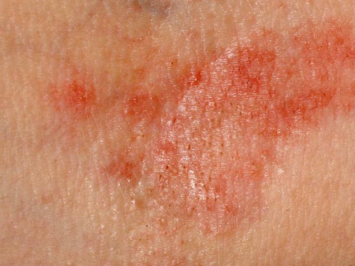 Dermatitis Pictures And Symptoms