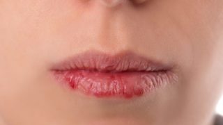 A close-shot of a woman's face with chapped, dry lips