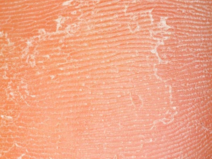 Remédios caseiros Para A Pele Seca Remédios caseiros Para A Pele Seca