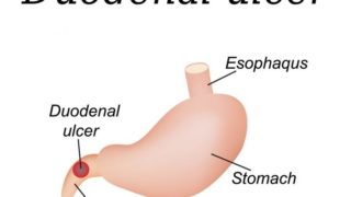 A 2D medical illustration of a stomach affected by duodenitis on a white background