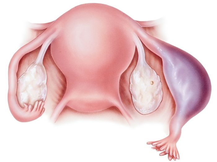 A graphic showing ectopic pregnancy
