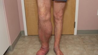 A man with a swollen leg suffering from edema