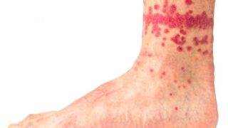 How To Get Rid Of Fleas