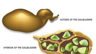 A 2D medical illustration of exterior and interior of gallbladder filled with gallstones on a white background