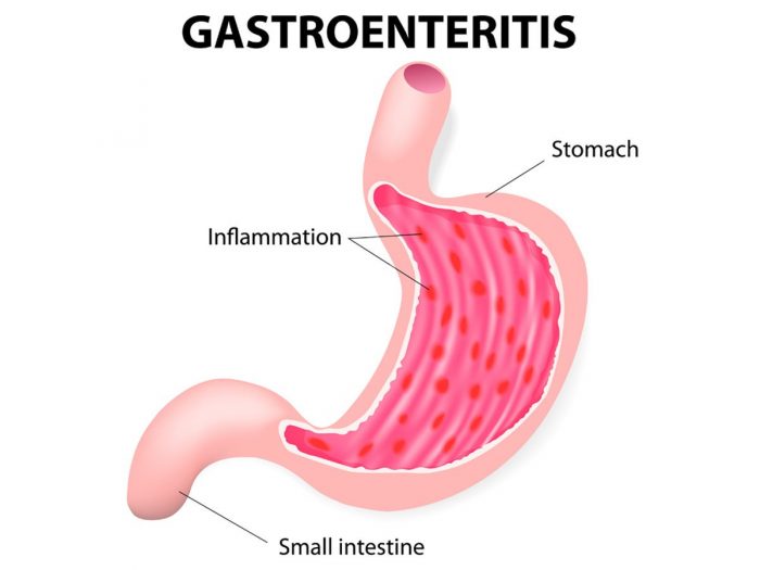 What are the best ways to treat stomach bug symptoms?