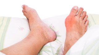 Swollen feet of a person with gout