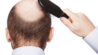 A young bald man suffering from hair loss on a white background