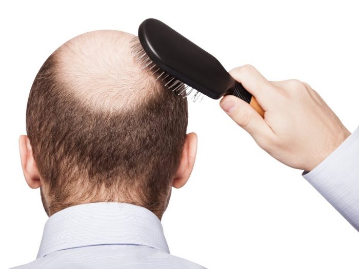 Remédios caseiros Para A Perda De Cabelo Em Homens